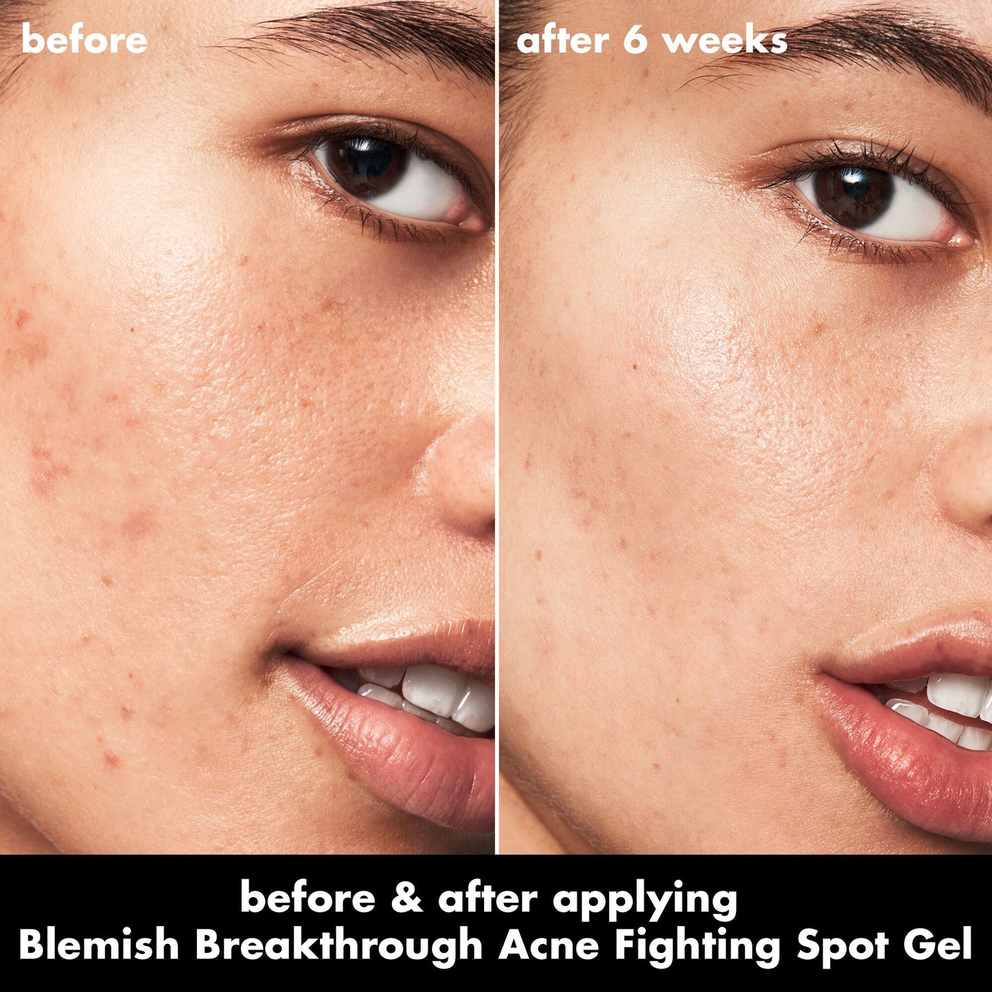 blemish-breakthrough-acne-fighting-spot-gel-i4 0326_EDU_BB_SpotGel_BA_ISABELLA.jpg