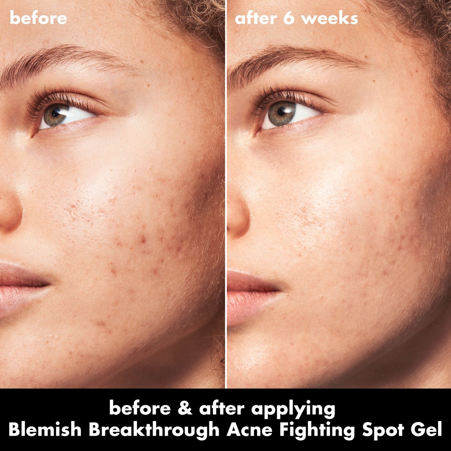 blemish-breakthrough-acne-fighting-spot-gel-i4 0326_EDU_BB_SpotGel_BA_MARLEY.jpg