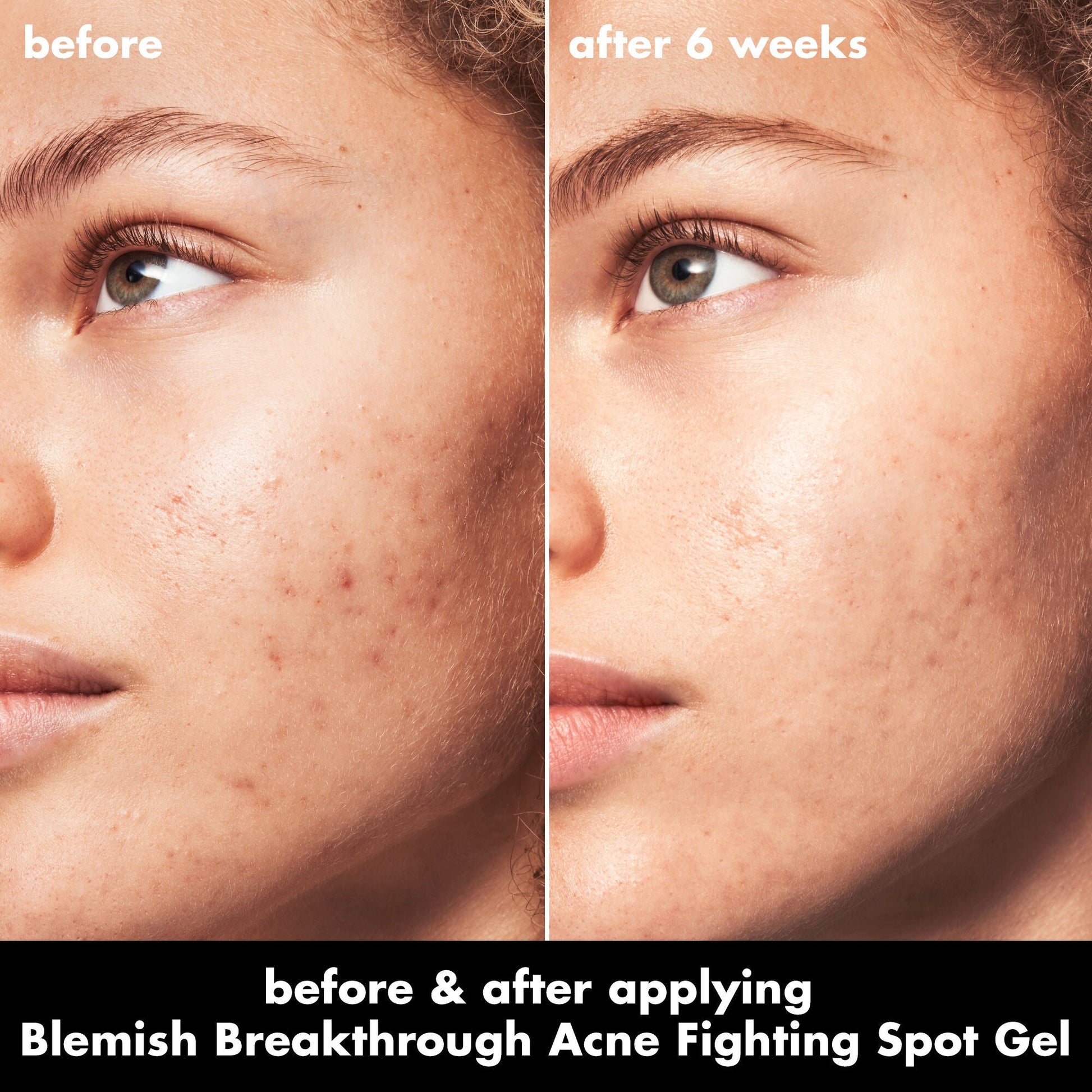 blemish-breakthrough-acne-fighting-spot-gel-i4 0326_EDU_BB_SpotGel_BA_MARLEY.jpg