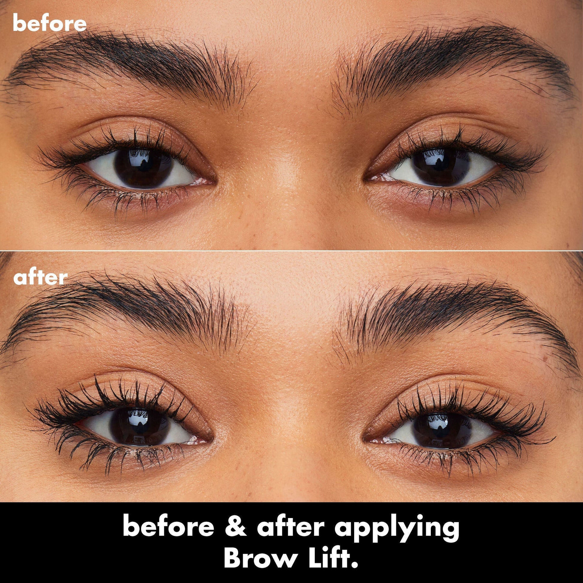 brow-lift-i9 0326_EDU_BrowLift_BA.jpg