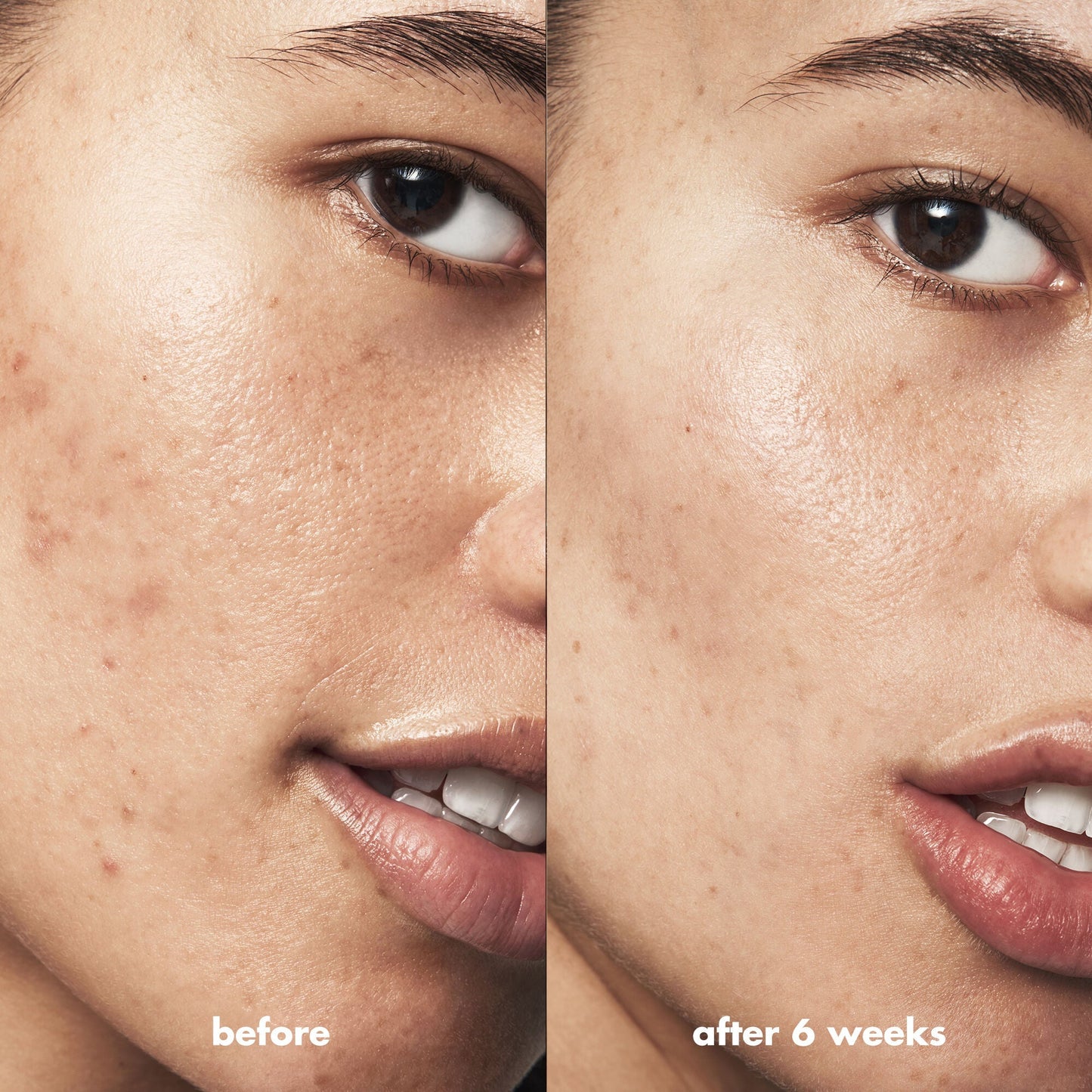 blemish-breakthrough-acne-clarifying-cleanser-v2 Acne_PDP_Isabella_Before_After_a3ff322b-cc6f-4b1a-9db3-bfb66c15d034.jpg