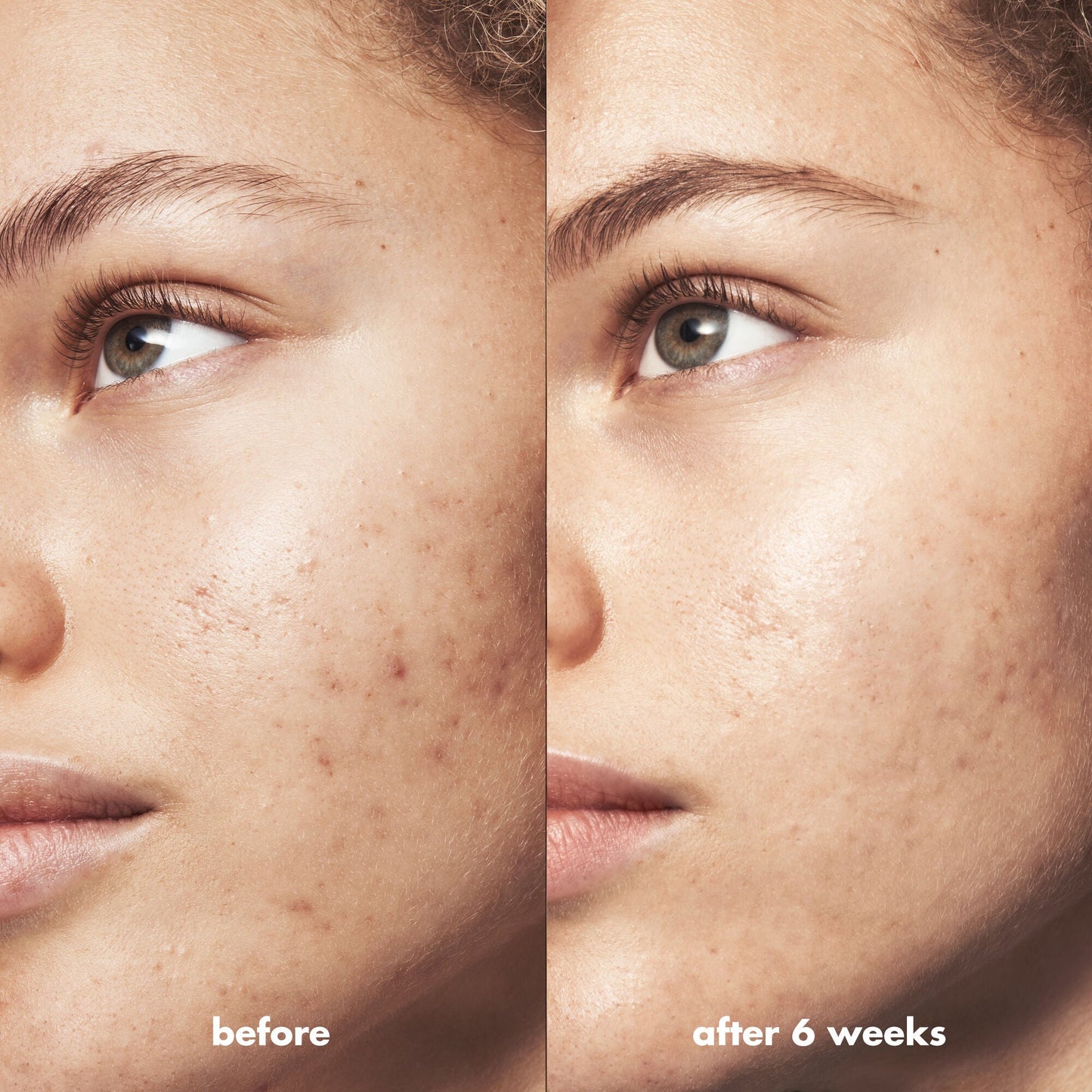 blemish-breakthrough-blemish-control-basics-kit-n7 Acne_PDP_Marley_Before_After_295728d2-6728-4f48-b8ef-c82bbca5b591.jpg